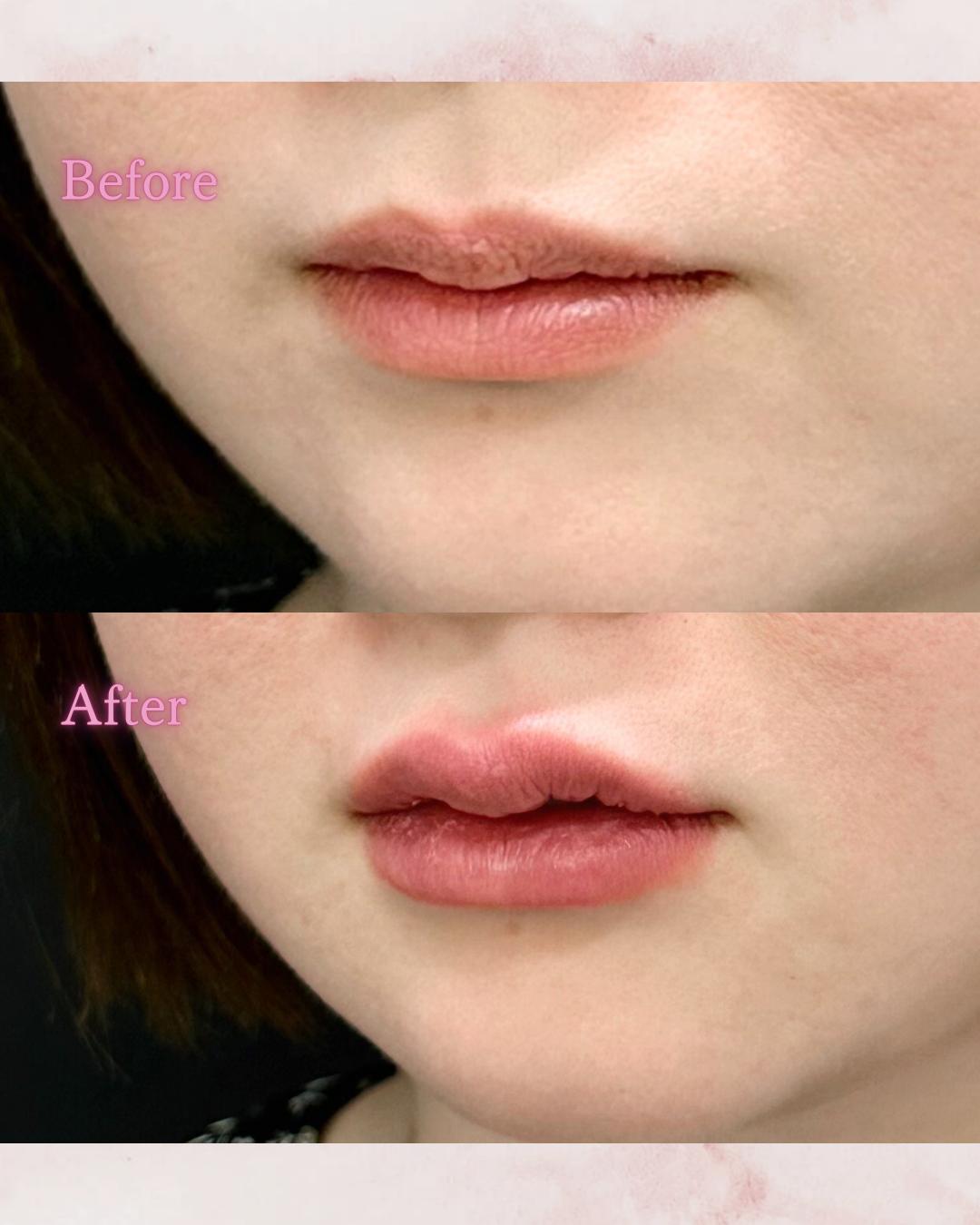 Cカールリップの症例写真