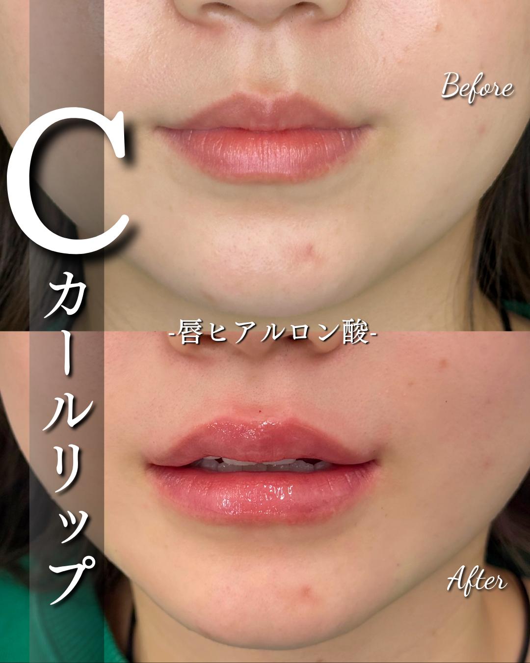 Cカールリップの症例写真