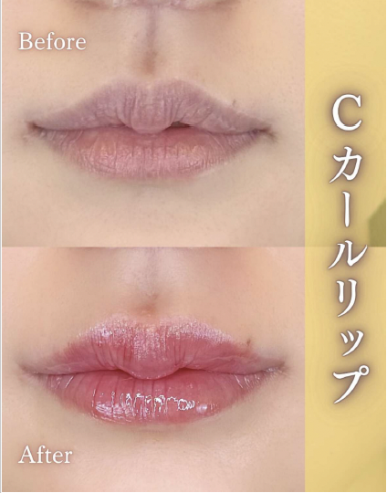 Cカールリップの症例写真