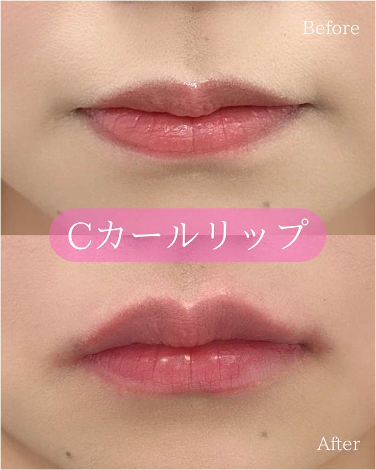 Cカールリップの症例写真