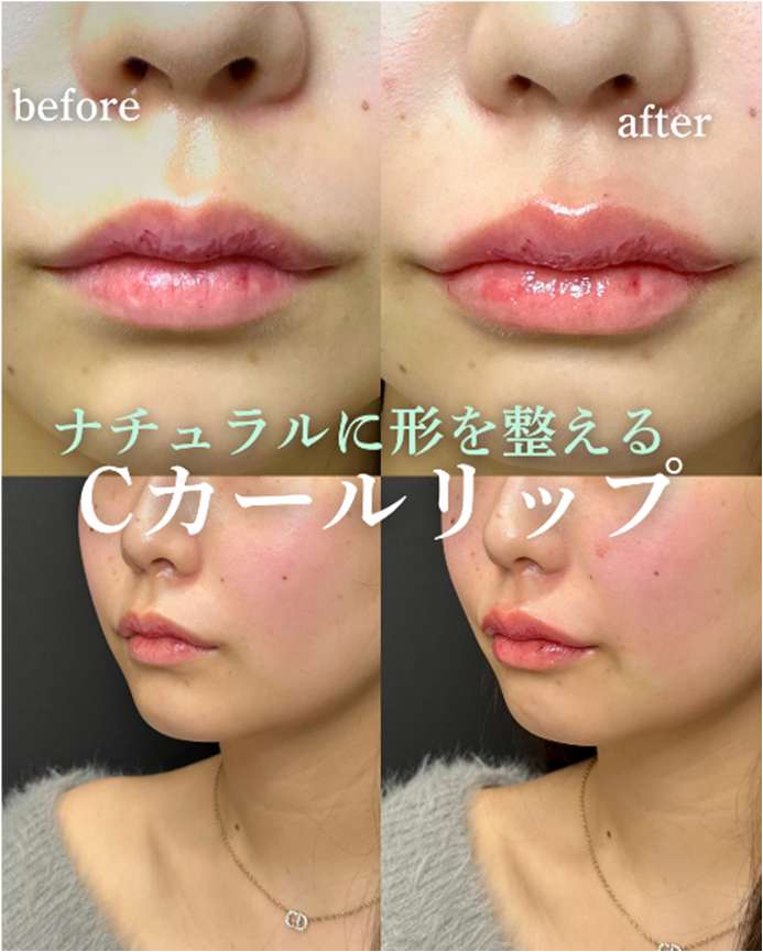 Cカールリップの症例写真