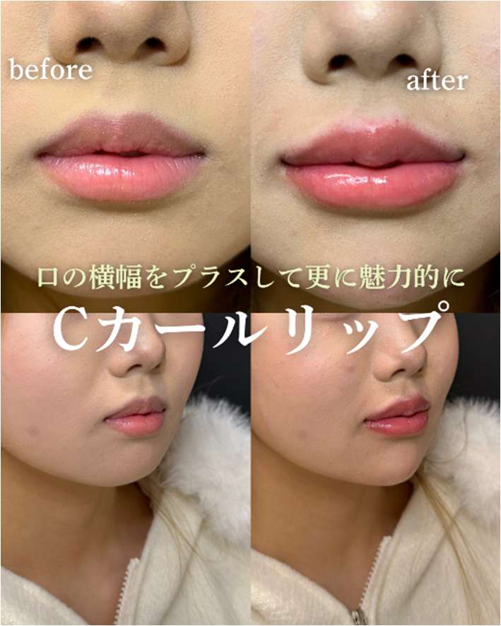 Cカールリップの症例写真
