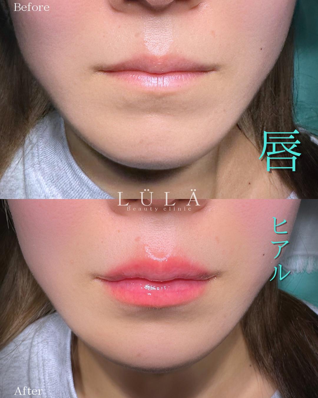 Cカールリップの症例写真