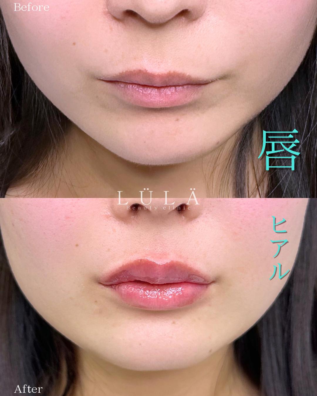 Cカールリップの症例写真