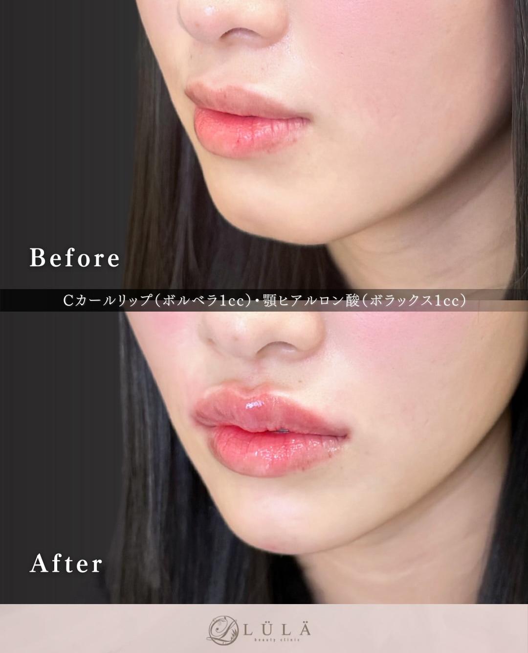 Cカールリップの症例写真