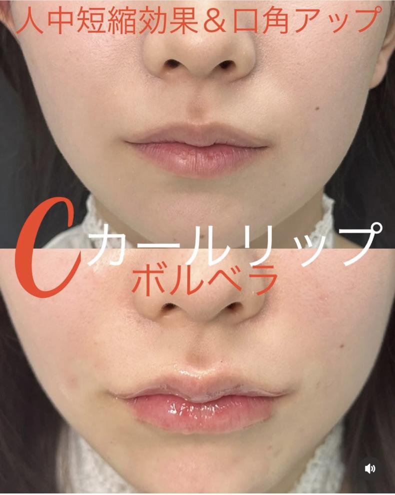 Cカールリップの症例写真