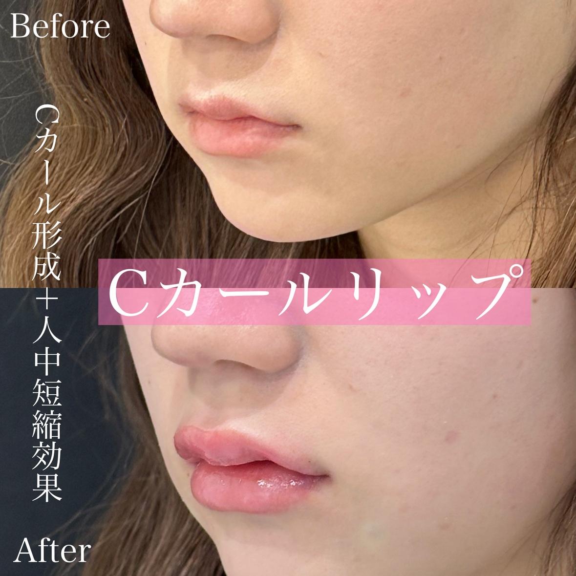 Cカールリップの症例写真