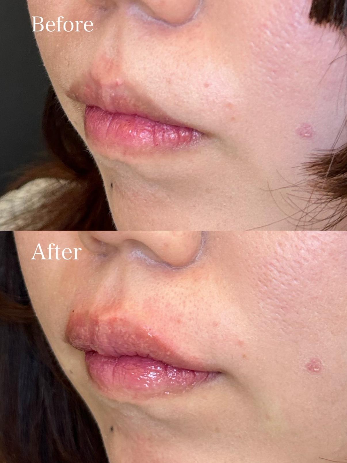 Cカールリップの症例写真