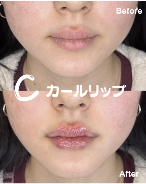 Cカールリップの症例写真