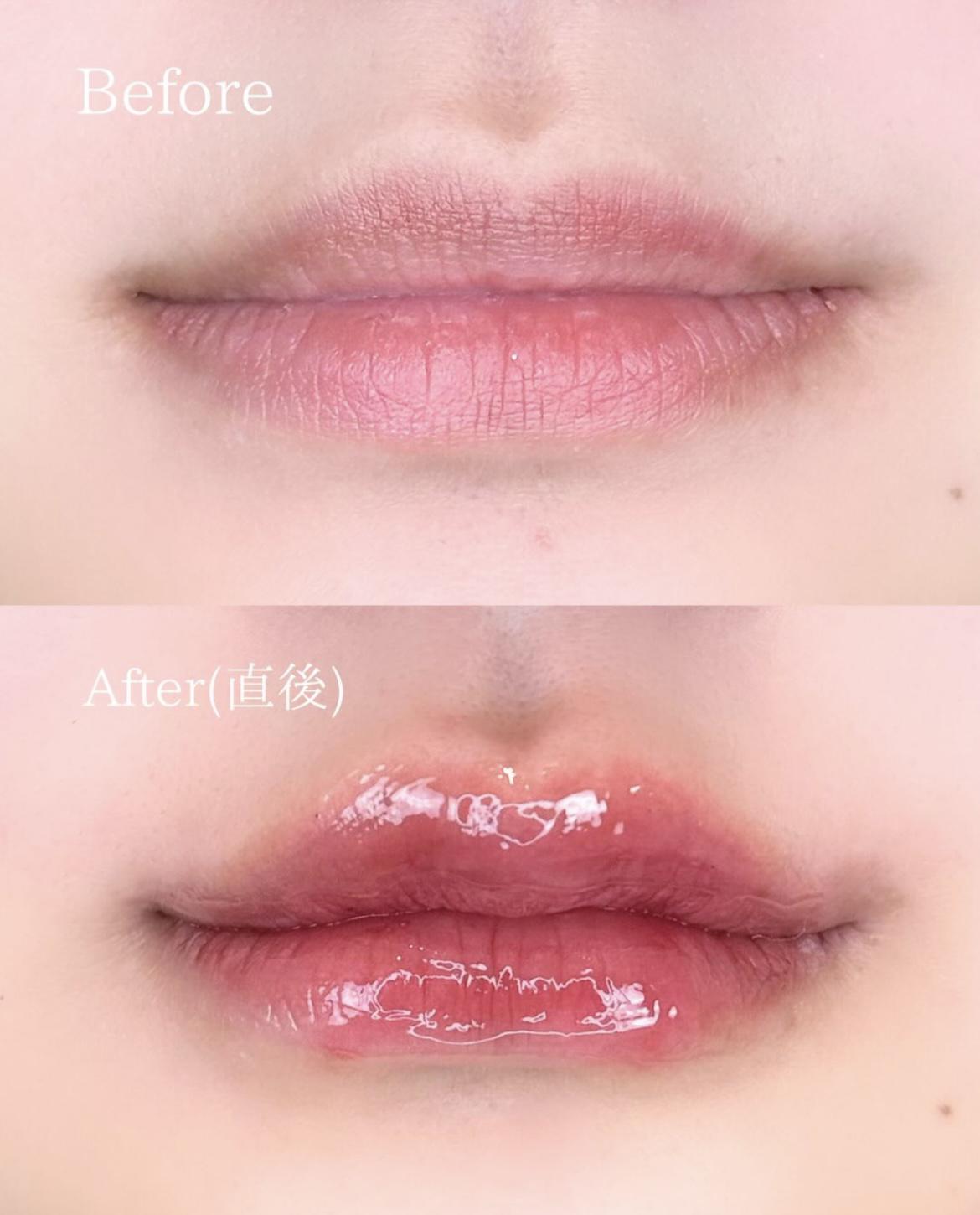 Cカールリップの症例写真