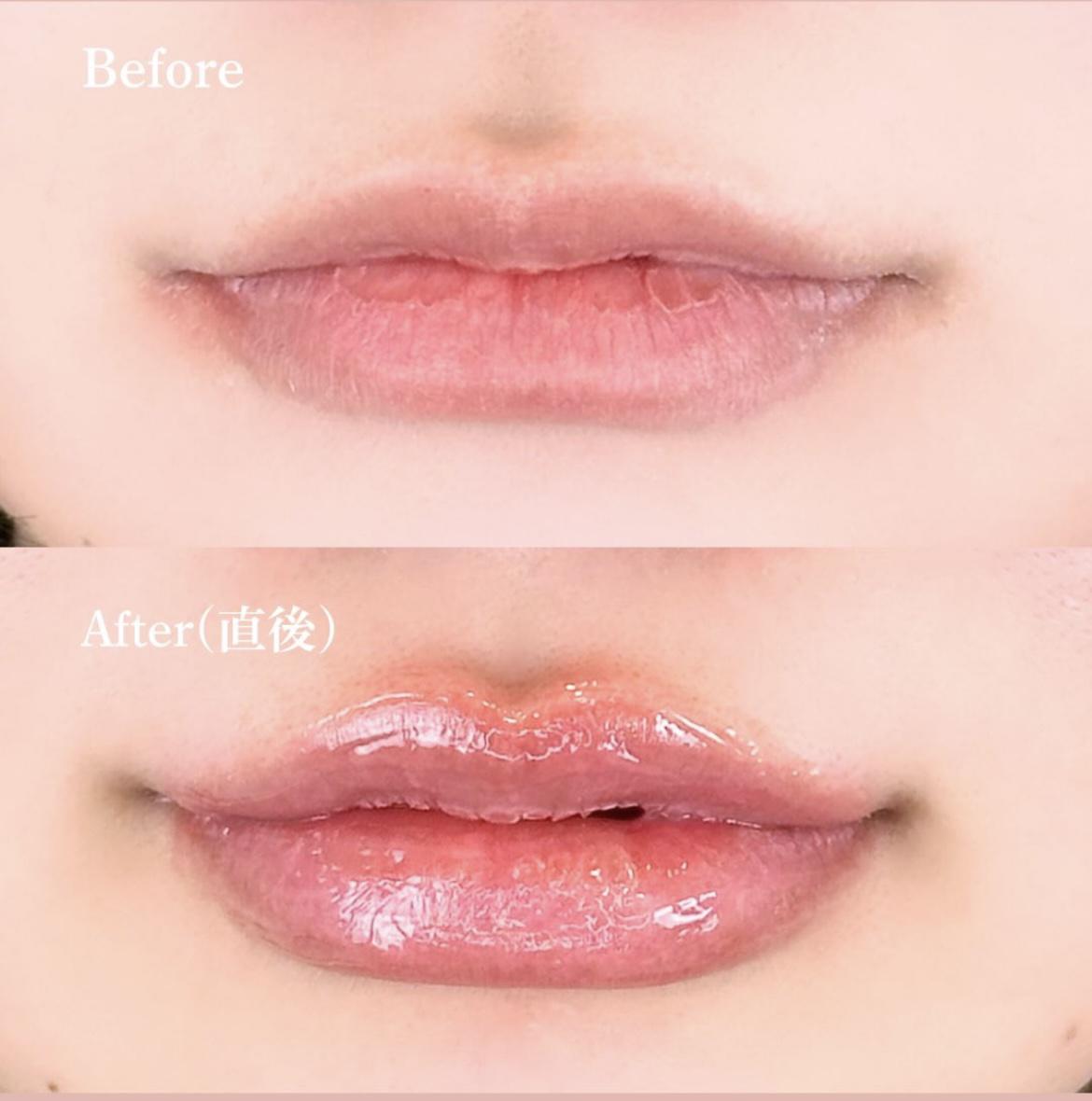 Cカールリップの症例写真