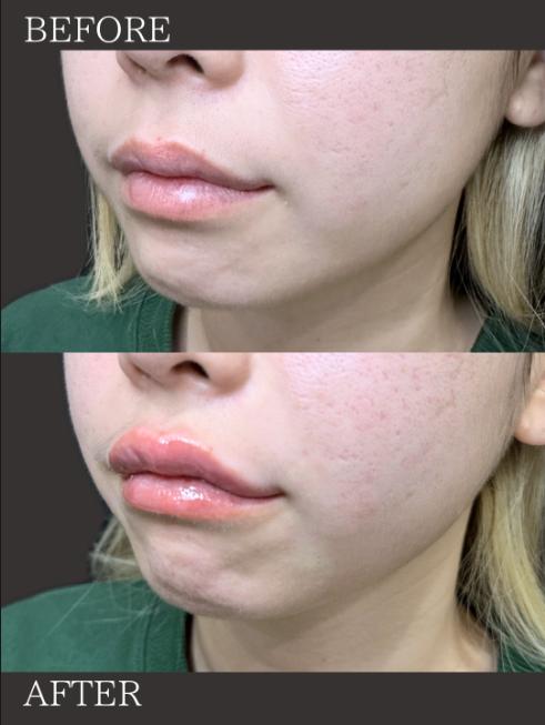 Cカールリップの症例写真