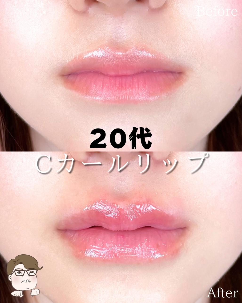 Cカールリップの症例写真