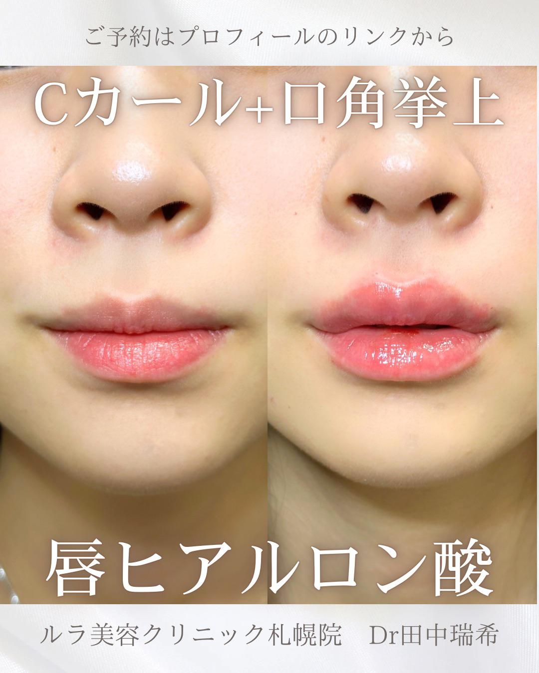 Cカールリップの症例写真