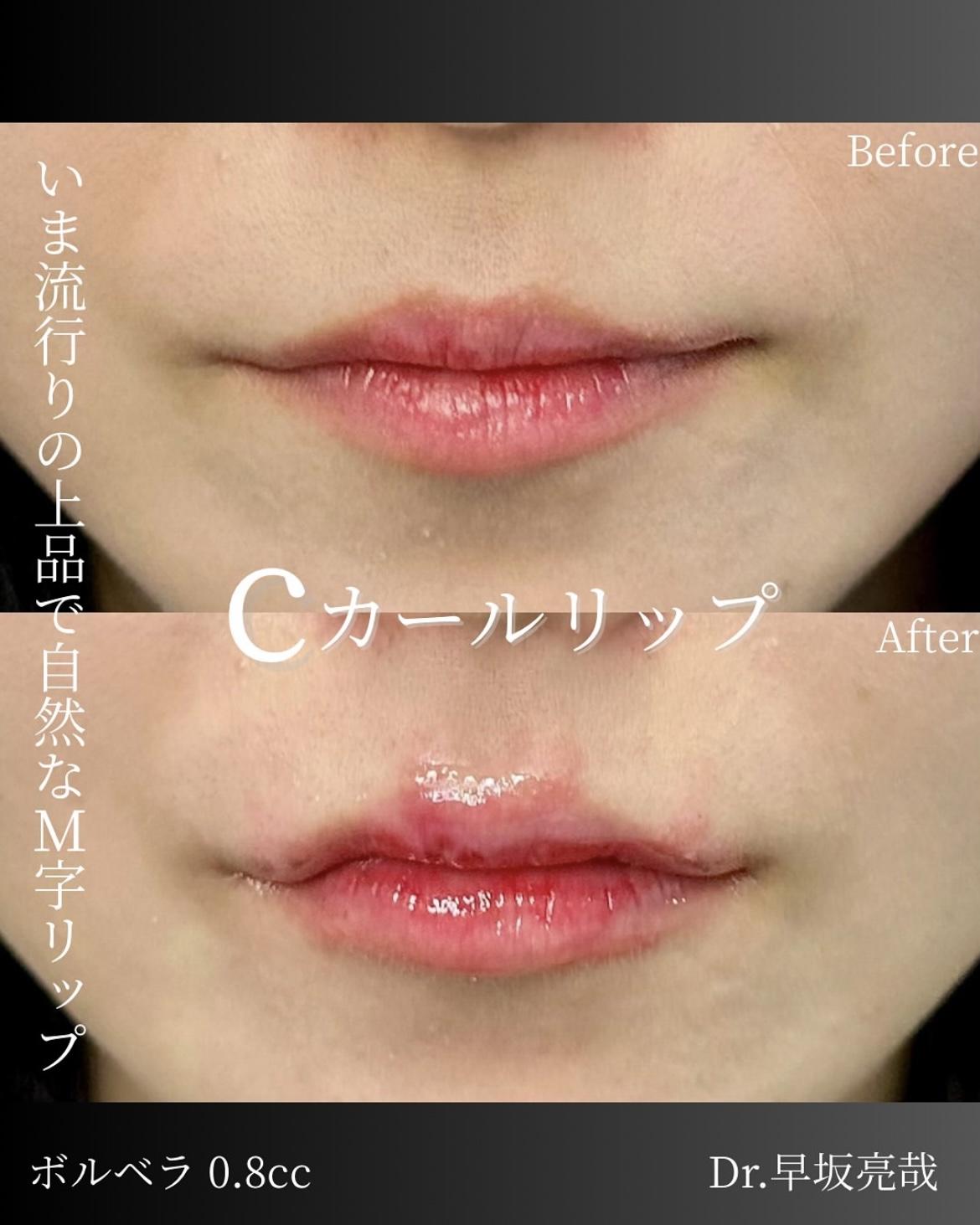 Cカールリップの症例写真