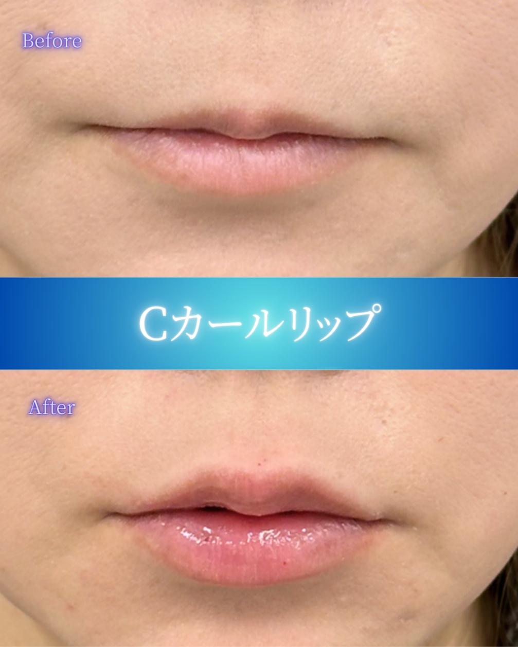 Cカールリップの症例写真