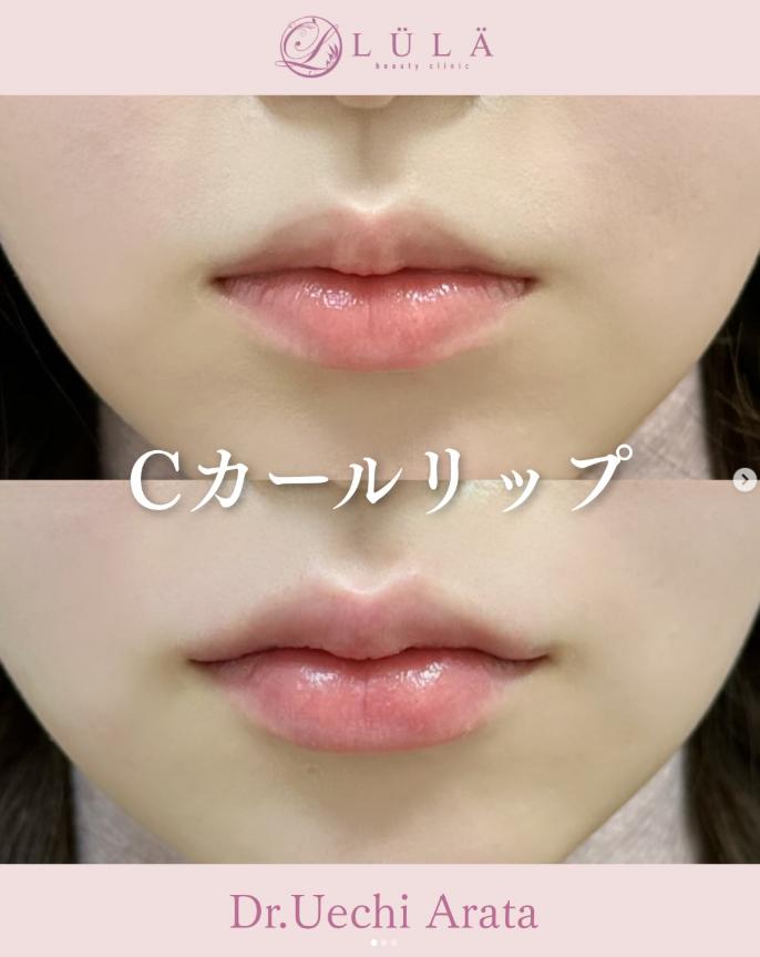 Cカールリップの症例写真