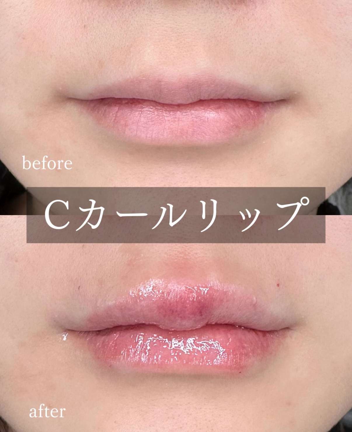 Cカールリップの症例写真