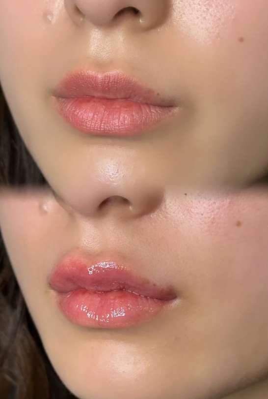 Cカールリップの症例写真