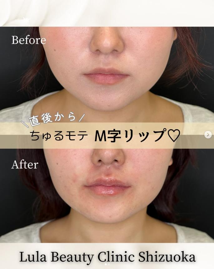 Cカールリップの症例写真