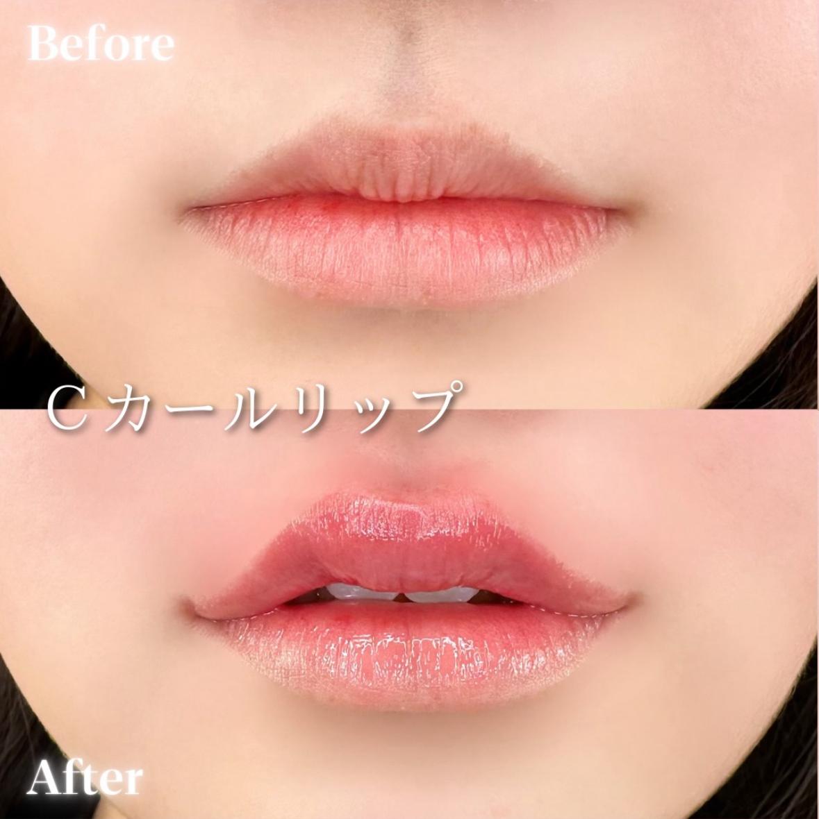 Cカールリップの症例写真