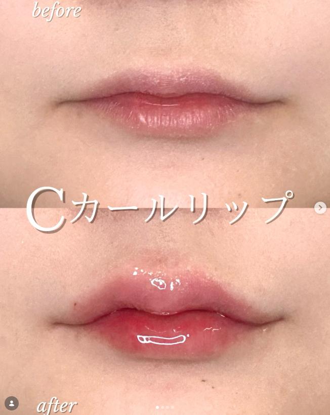 Cカールリップの症例写真