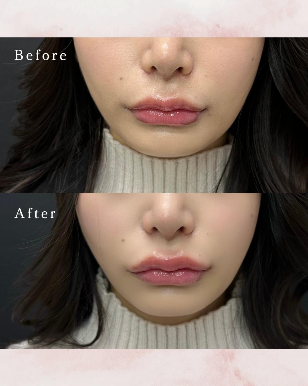 Cカールリップの症例写真