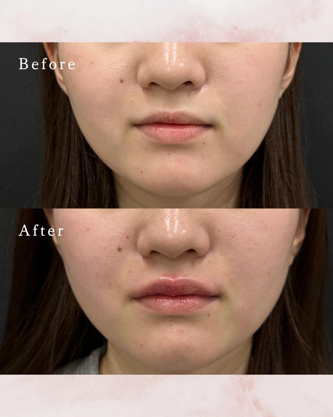 Cカールリップの症例写真