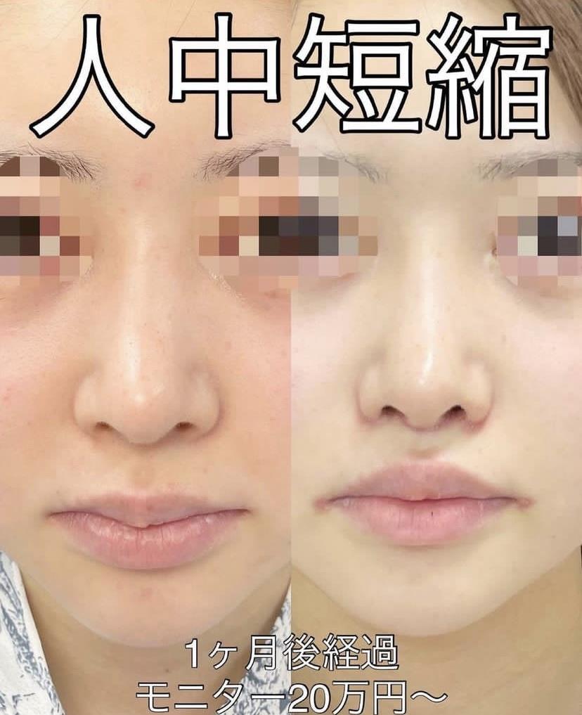 人中短縮手術(リフトアップ)の症例写真