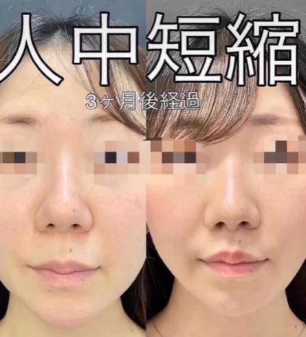 人中短縮手術(リフトアップ)の症例写真