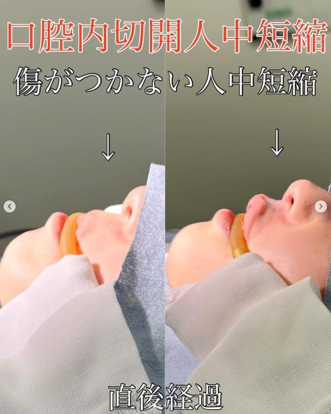 人中短縮手術(リフトアップ)の症例写真