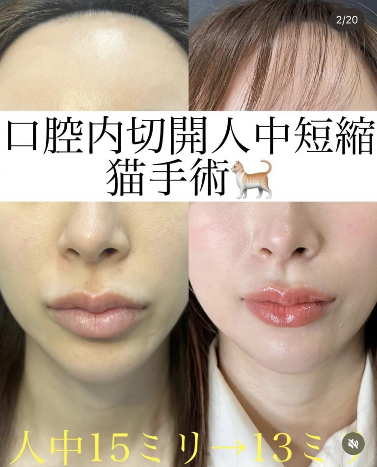 人中短縮手術(リフトアップ)の症例写真
