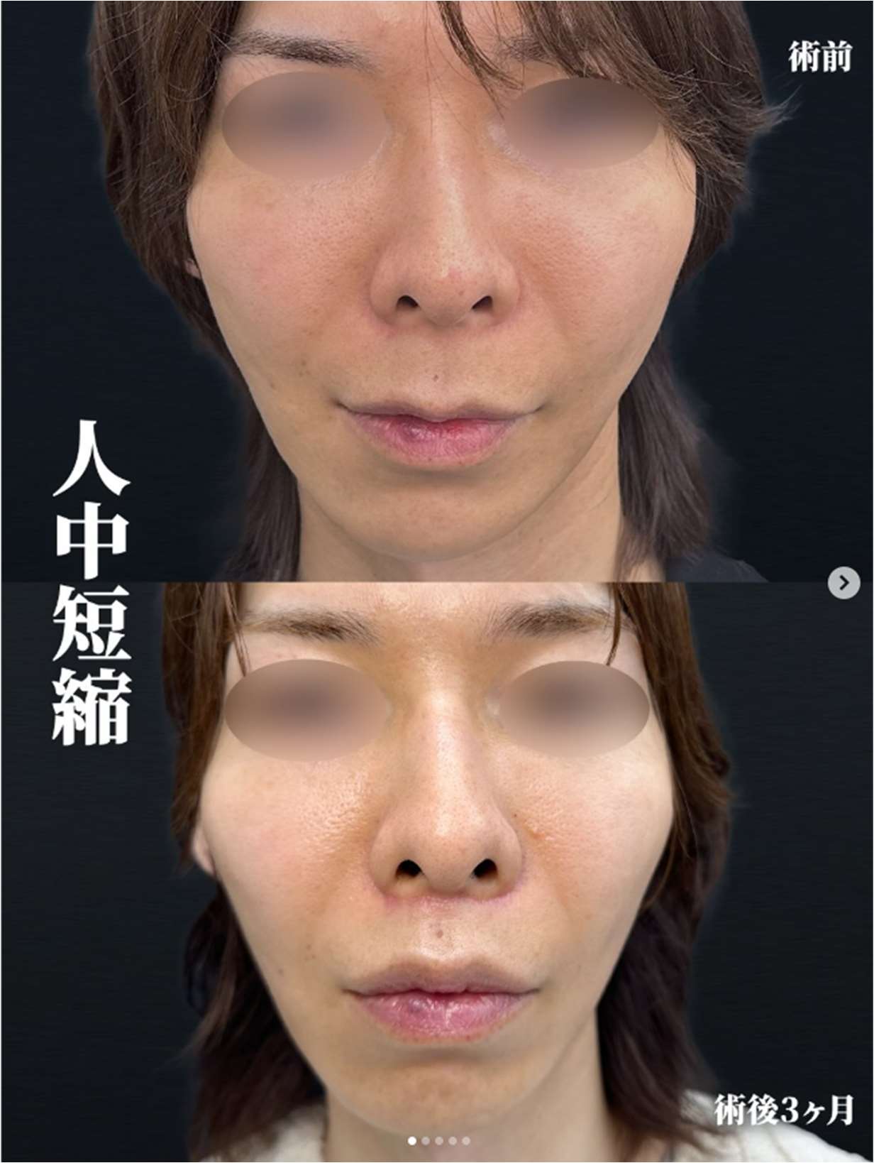 人中短縮手術(リフトアップ)の症例写真