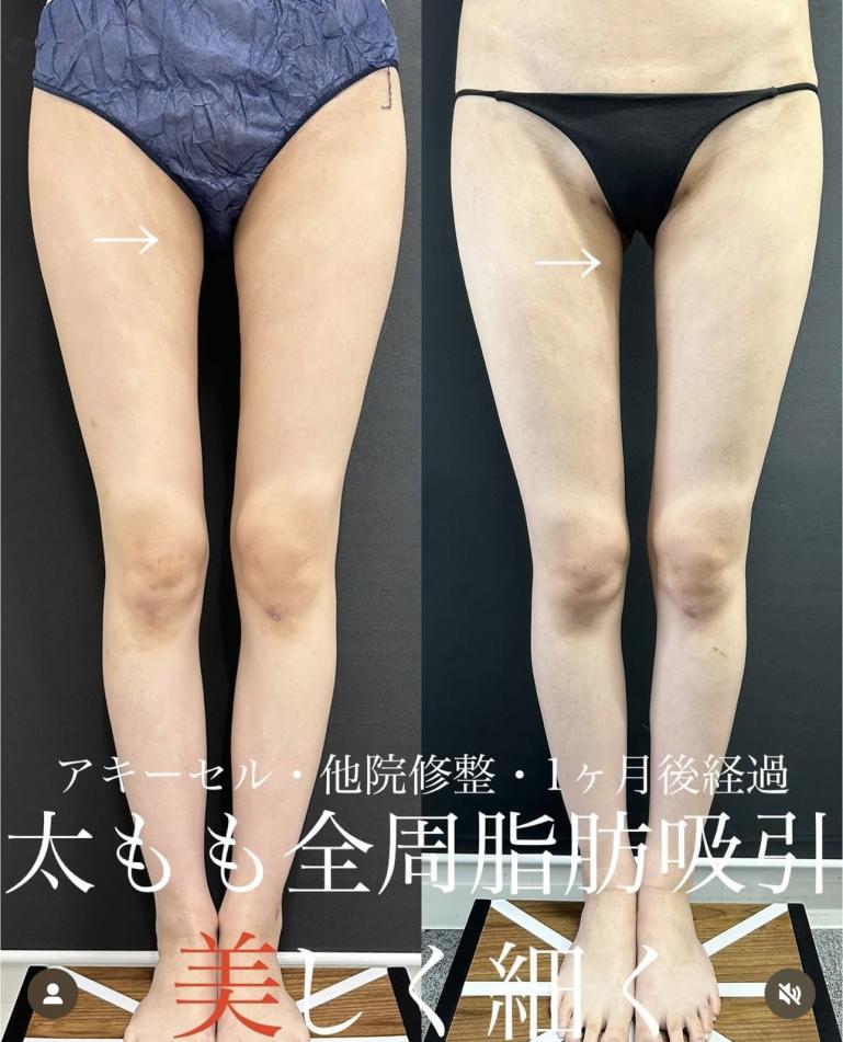 脂肪吸引の症例写真