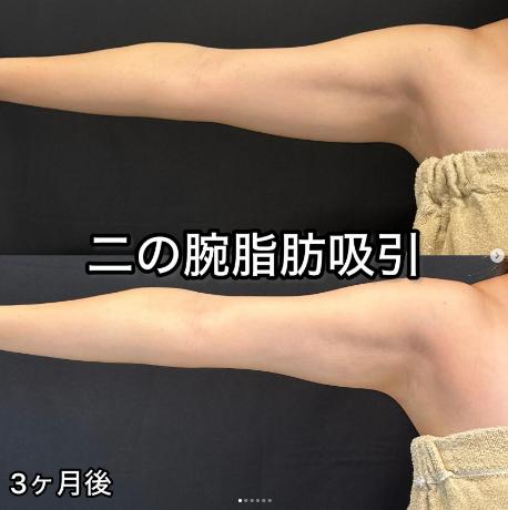 脂肪吸引の症例写真
