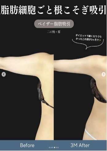 脂肪吸引の症例写真