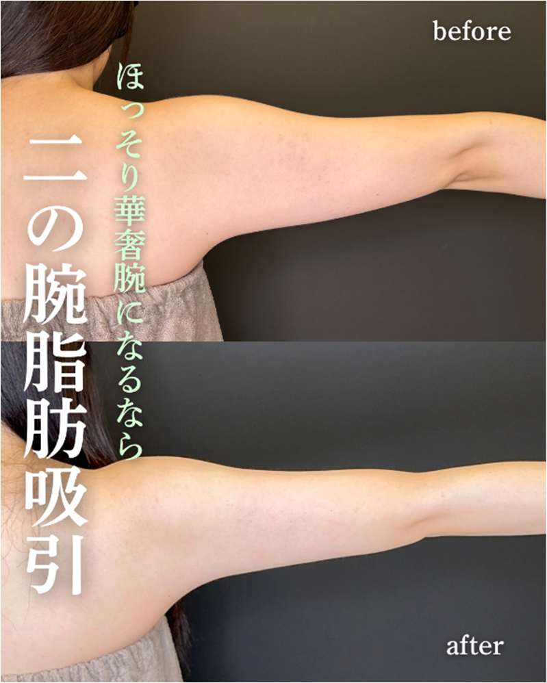 脂肪吸引の症例写真