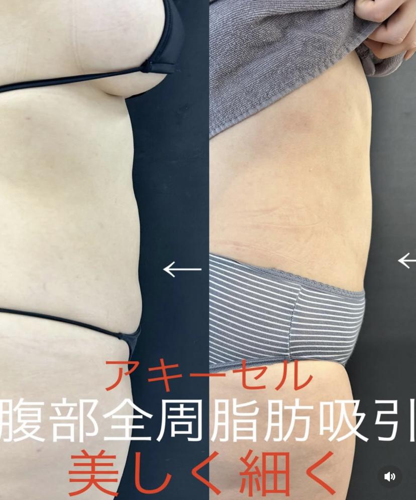 脂肪吸引の症例写真