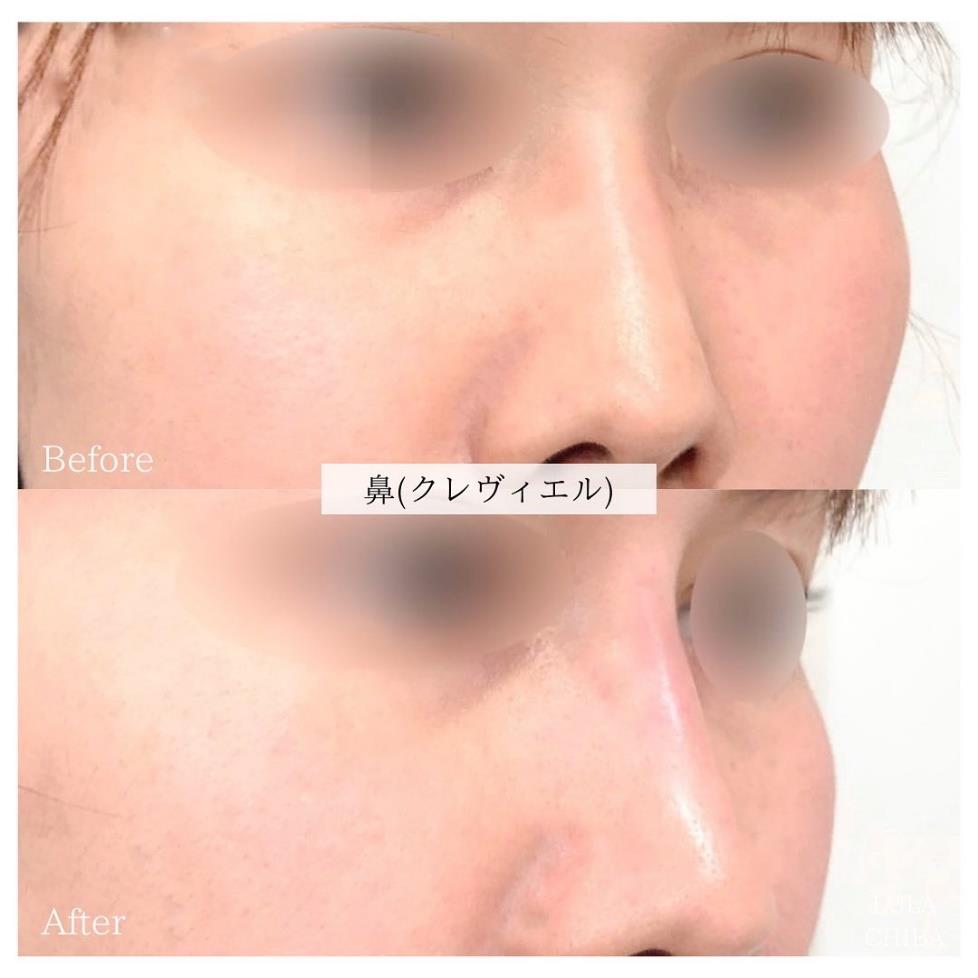 鼻ヒアルロン酸注入の症例写真