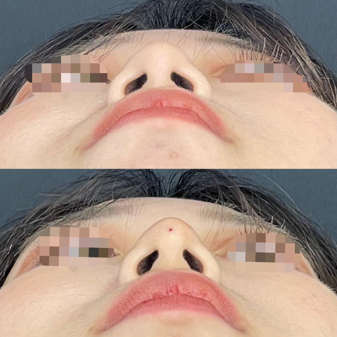 鼻ヒアルロン酸注入の症例写真
