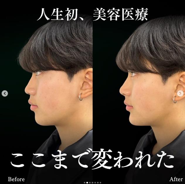 鼻ヒアルロン酸注入の症例写真