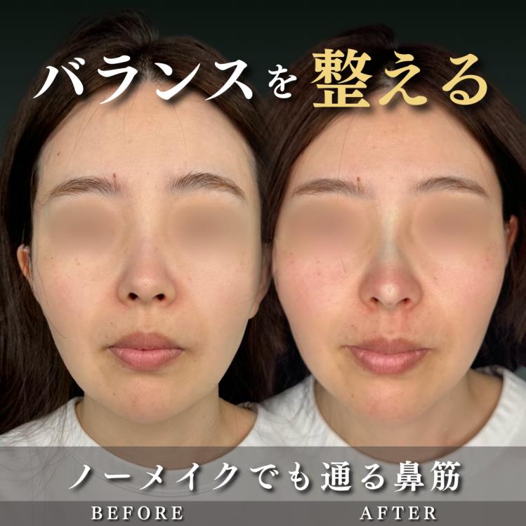 鼻ヒアルロン酸注入の症例写真