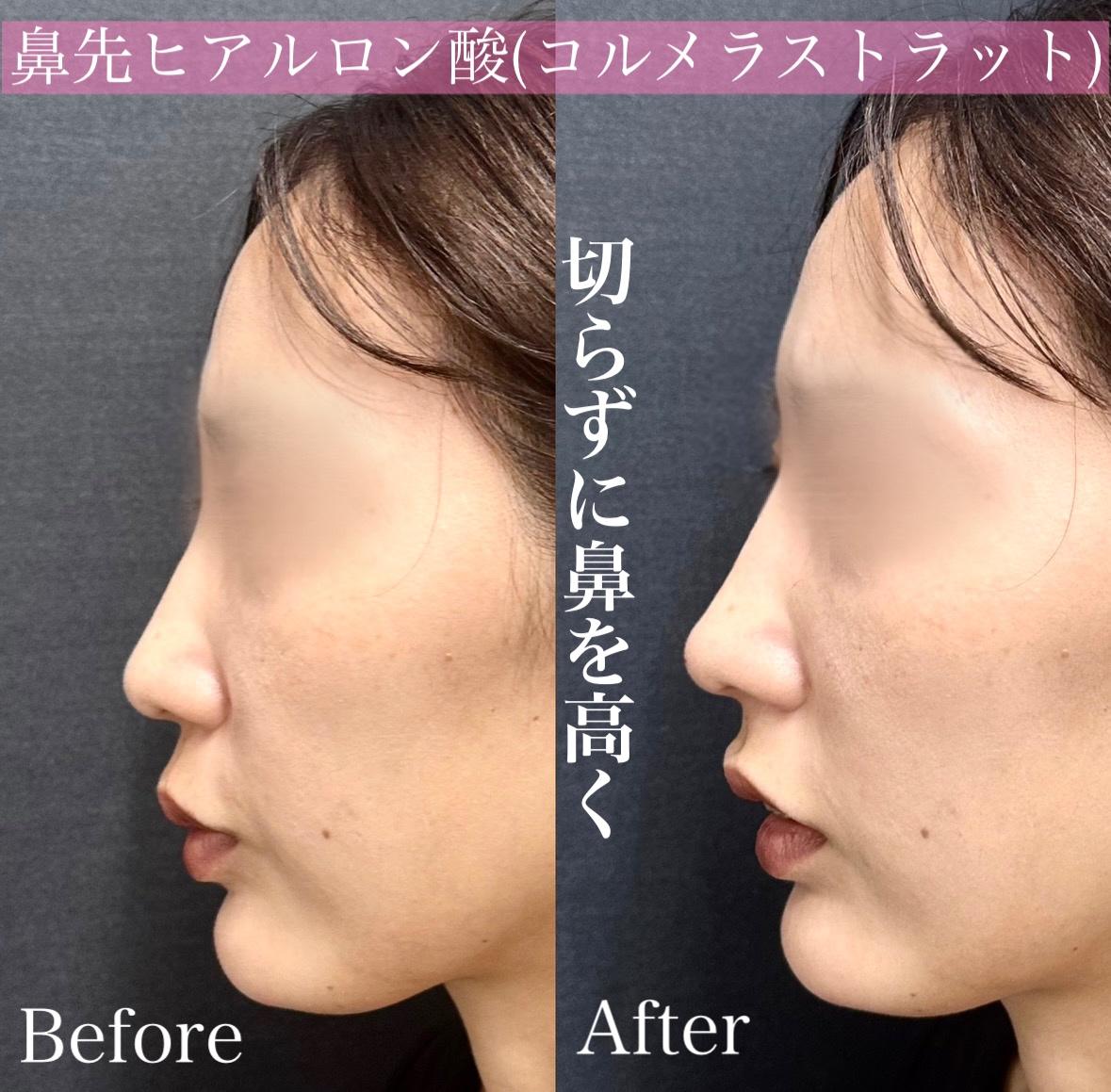 鼻ヒアルロン酸注入の症例写真