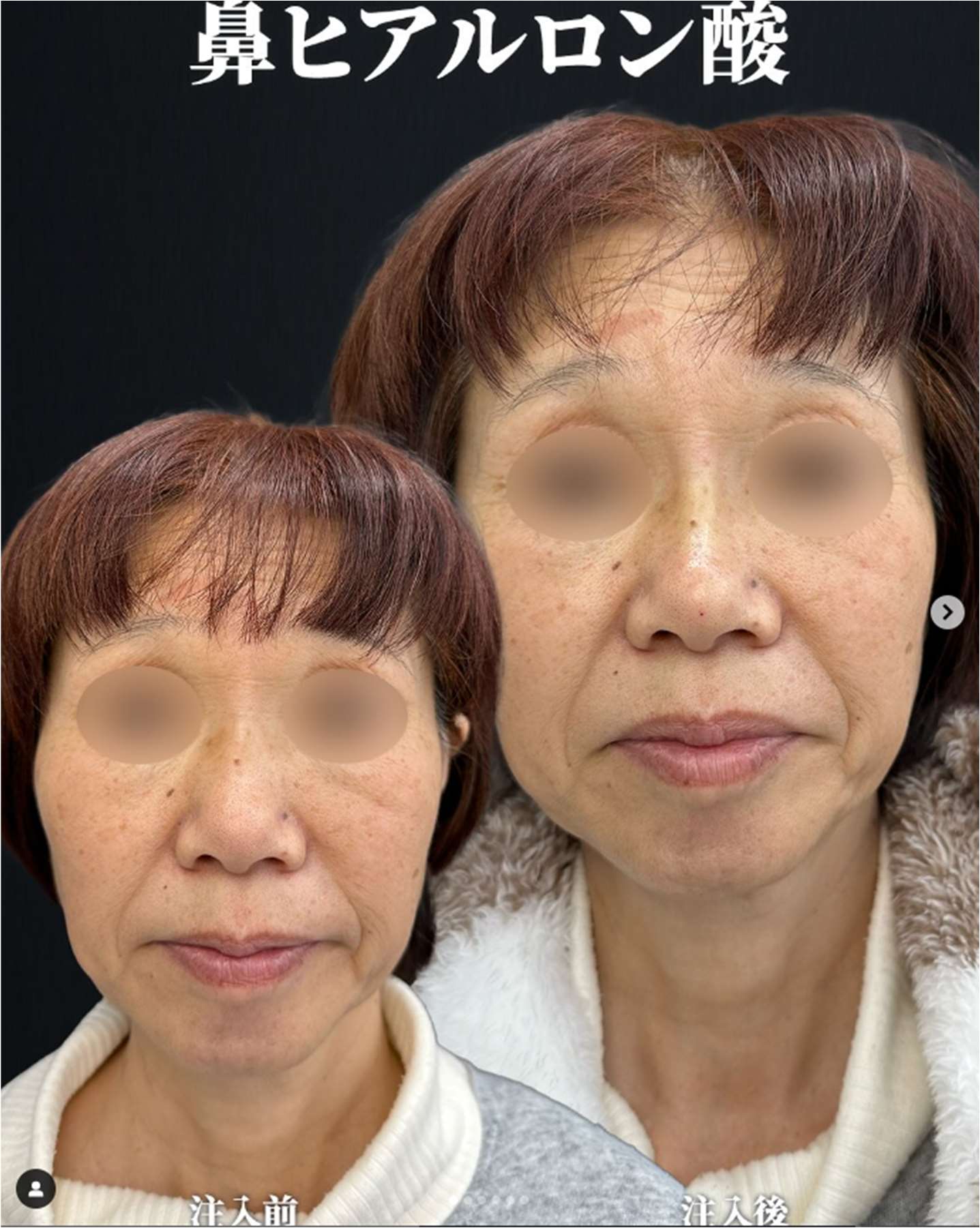 鼻ヒアルロン酸注入の症例写真