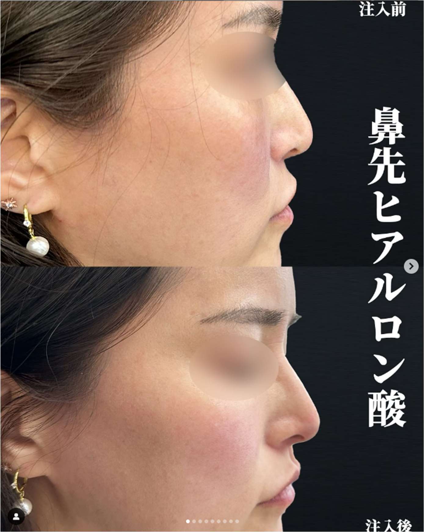 鼻ヒアルロン酸注入の症例写真