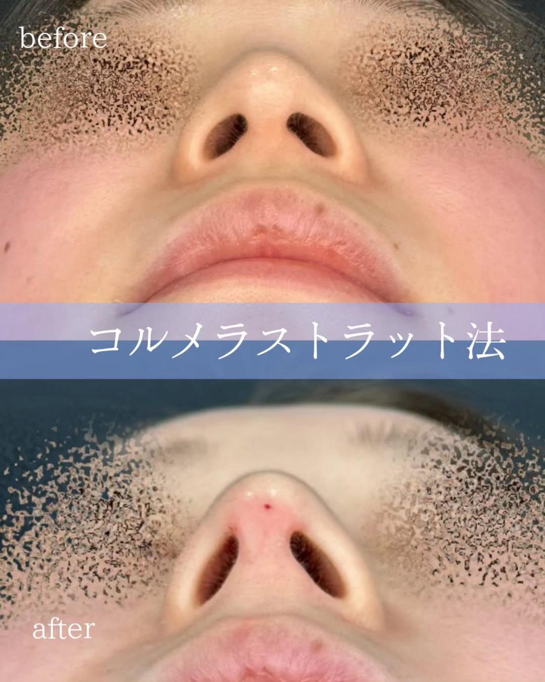 鼻ヒアルロン酸注入の症例写真