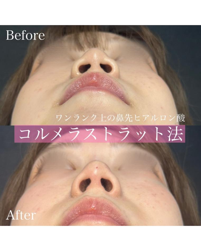 鼻ヒアルロン酸注入の症例写真