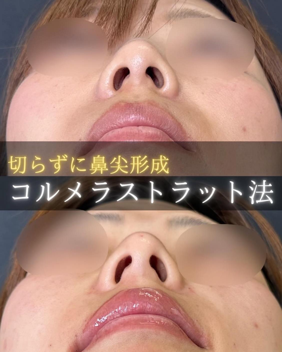 鼻ヒアルロン酸注入の症例写真