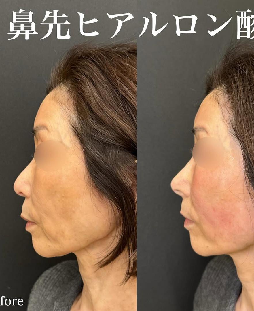 鼻ヒアルロン酸注入の症例写真