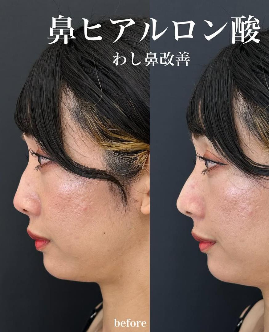 鼻ヒアルロン酸注入の症例写真